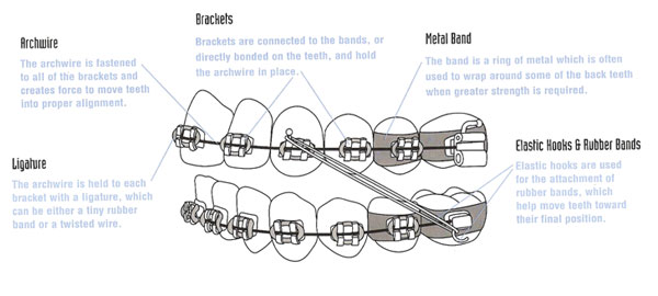 Parts of Braces
